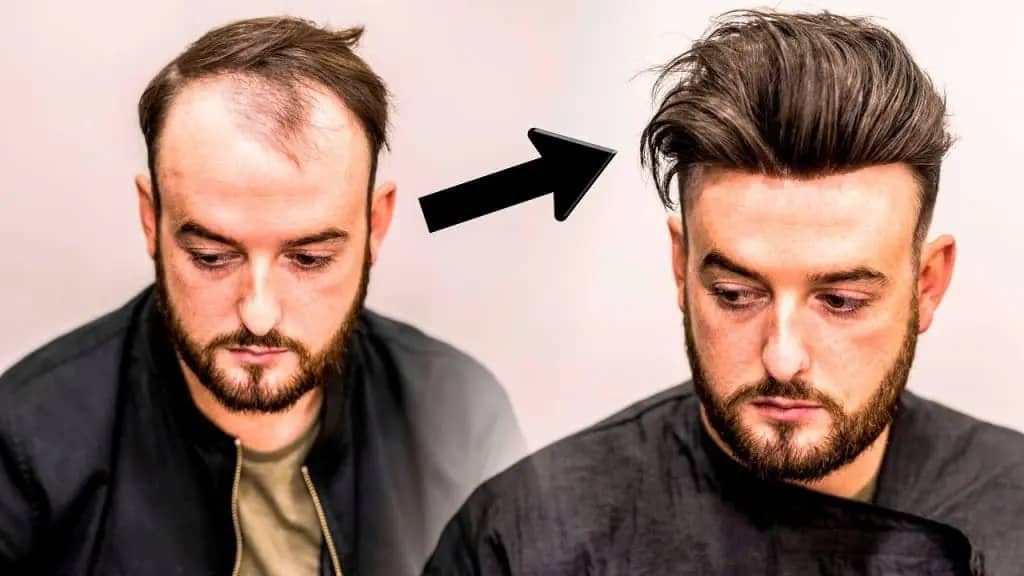 antes e depois de minoxidil no cabelo