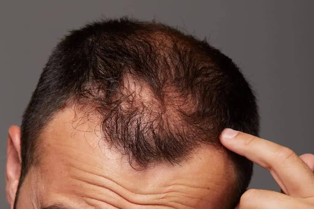 Quais os efeitos colaterais do Minoxidil? 3 couro cabeludo vermelho 1024x683 2