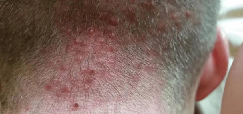 Quais os efeitos colaterais do Minoxidil? 4 espinhas no couro cabeludo o que pode ser 01042019113353 compressed
