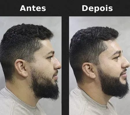 Minoxidil para Barba: O Caminho Certeiro para uma Barba Cheia e Vistosa 4 Preenchedor de Falhas na Barba Antes e depois 2