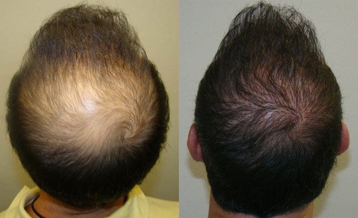 antes e depois